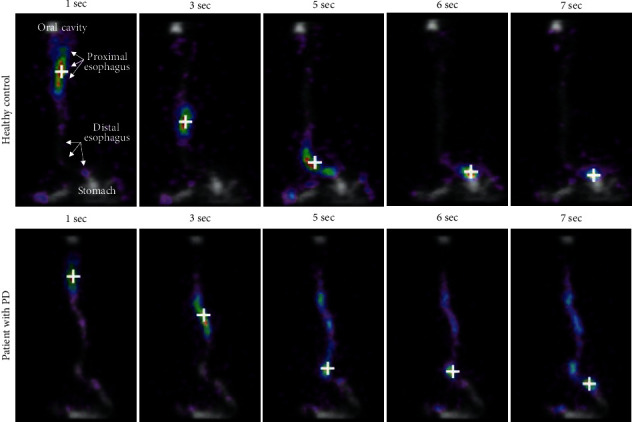 Intestinal Transit in Early Moderate Parkinson's Disease Correlates with Probable RBD: Subclinical Esophageal Dysmotility Does Not Correlate.