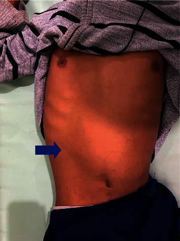 A Strangulated Congenital Diaphragmatic Bochdalek Hernia Diagnosed in an Adult.