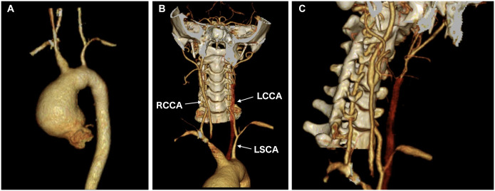 Single-stage repair for ascending aortic aneurysm, artery stenosis and occlusion of neck vessels caused by Takayasu arteritis.