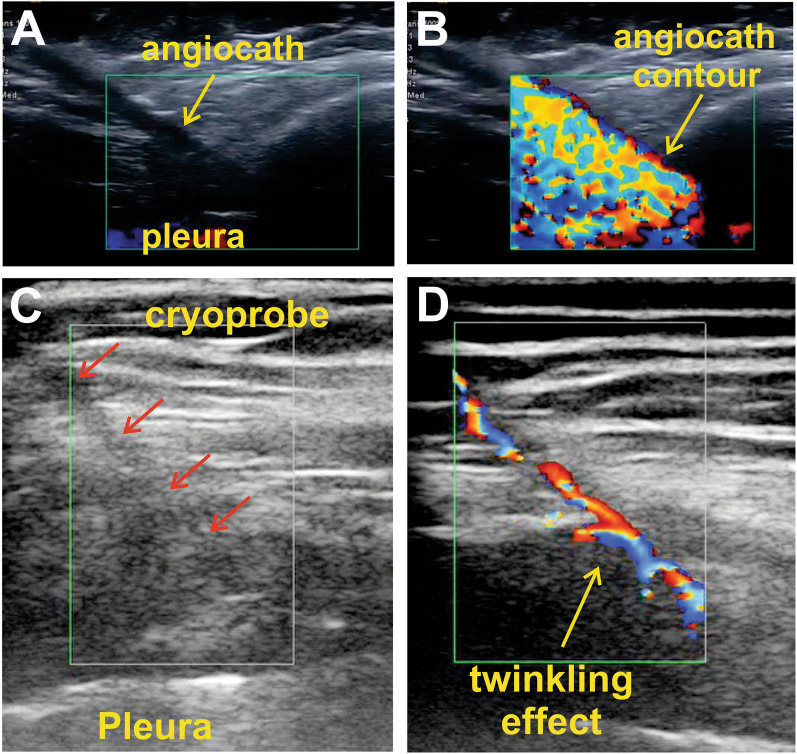 Short communication: ultrasound-guided percutaneous cryoanalgesia of intercostal nerves for uniportal video-assisted thoracic surgery.