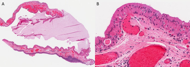 Oncocytic Papillary Cystadenoma, an Unusual Variant Presenting as a Laryngeal Ventricular Cyst.