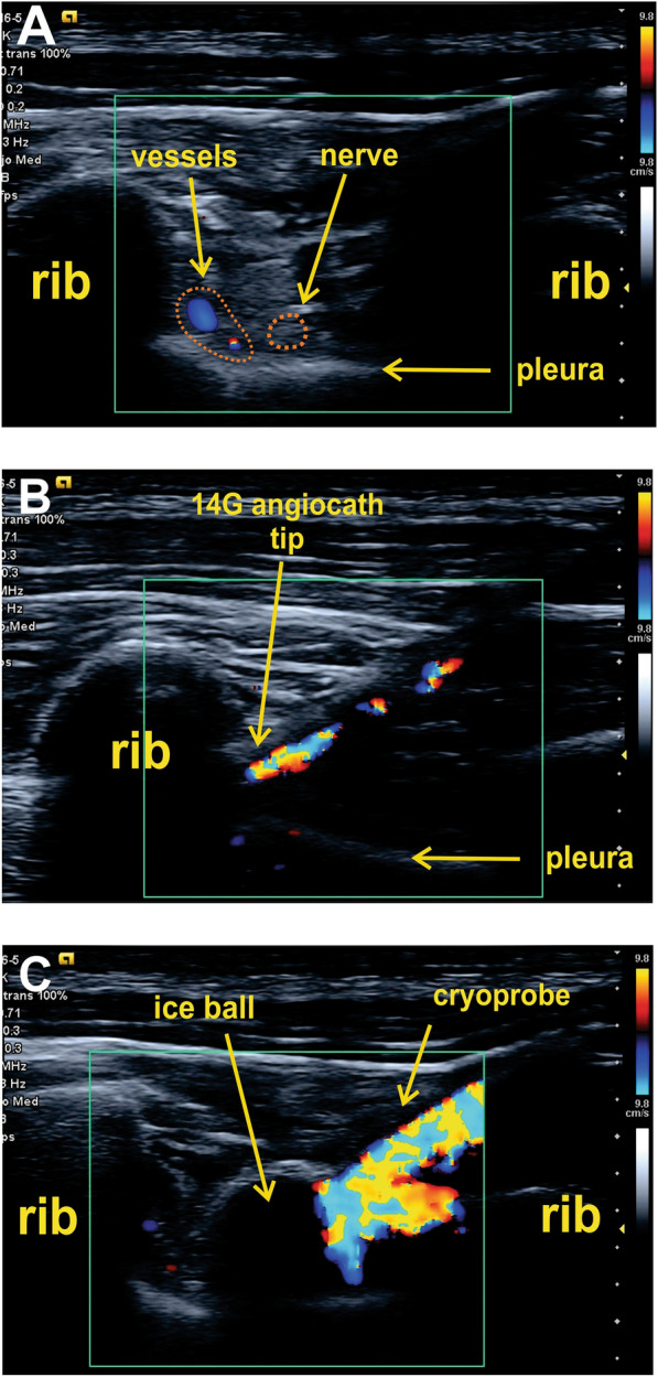 Short communication: ultrasound-guided percutaneous cryoanalgesia of intercostal nerves for uniportal video-assisted thoracic surgery.