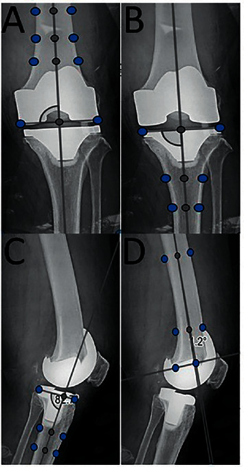 Total Knee Arthroplasty, All-in-One versus Four-in-One Femoral Cutting Jig System: A Comparison Study.