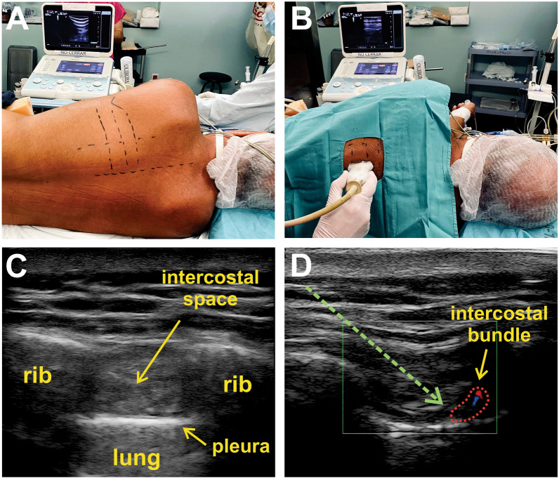 Short communication: ultrasound-guided percutaneous cryoanalgesia of intercostal nerves for uniportal video-assisted thoracic surgery.