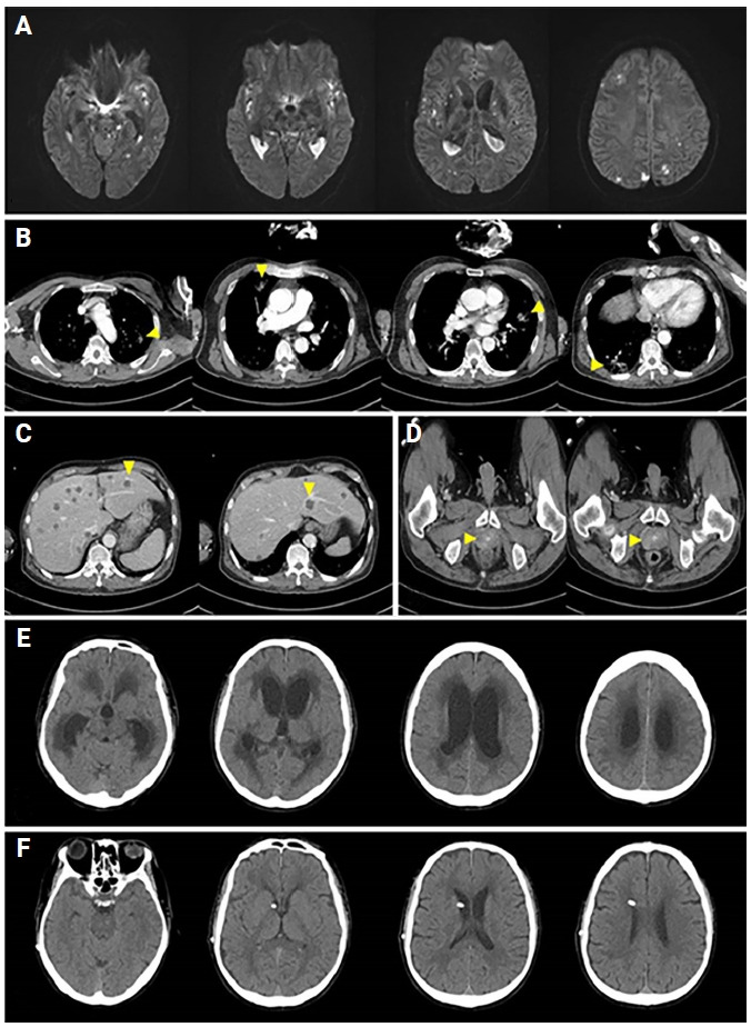 A case of invasive <i>Klebsiella pneumoniae</i> syndrome with ventriculitis.
