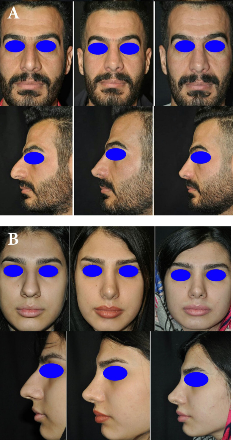 Evaluation of Clinical Outcomes and Satisfaction of Rhinoplasty with or without Smasectomy with the Aim of Thinning the Nasal Tip in Patients with Thick Nasal Skin.