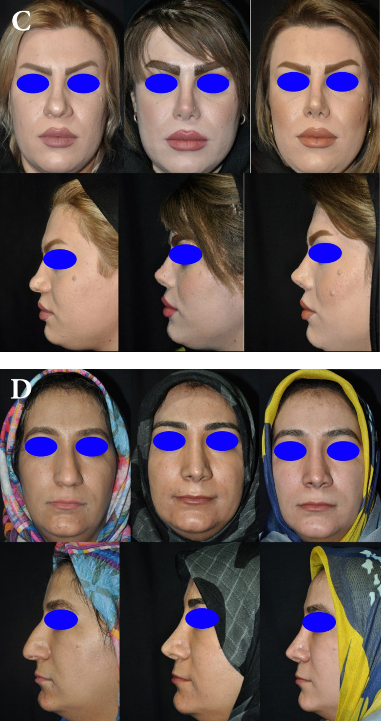 Evaluation of Clinical Outcomes and Satisfaction of Rhinoplasty with or without Smasectomy with the Aim of Thinning the Nasal Tip in Patients with Thick Nasal Skin.