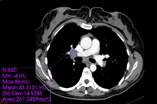 Diagnostic Value of Radiographic Characteristics of Mediastinal and Hilar Lymph Nodes in Sarcoidosis.