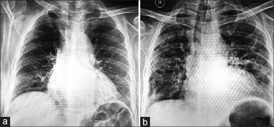 Hypercalcemia with methotrexate pneumonitis: A rare, important and intriguing adverse event.