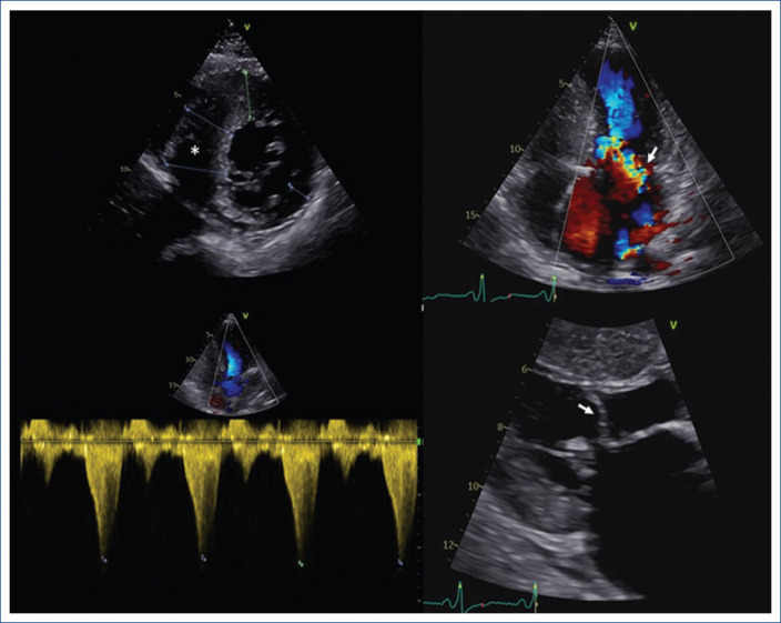 Pregnancy and severe left ventricle outflow tract obstruction in Hypertrophic Cardiomyopathy: a case report and review.