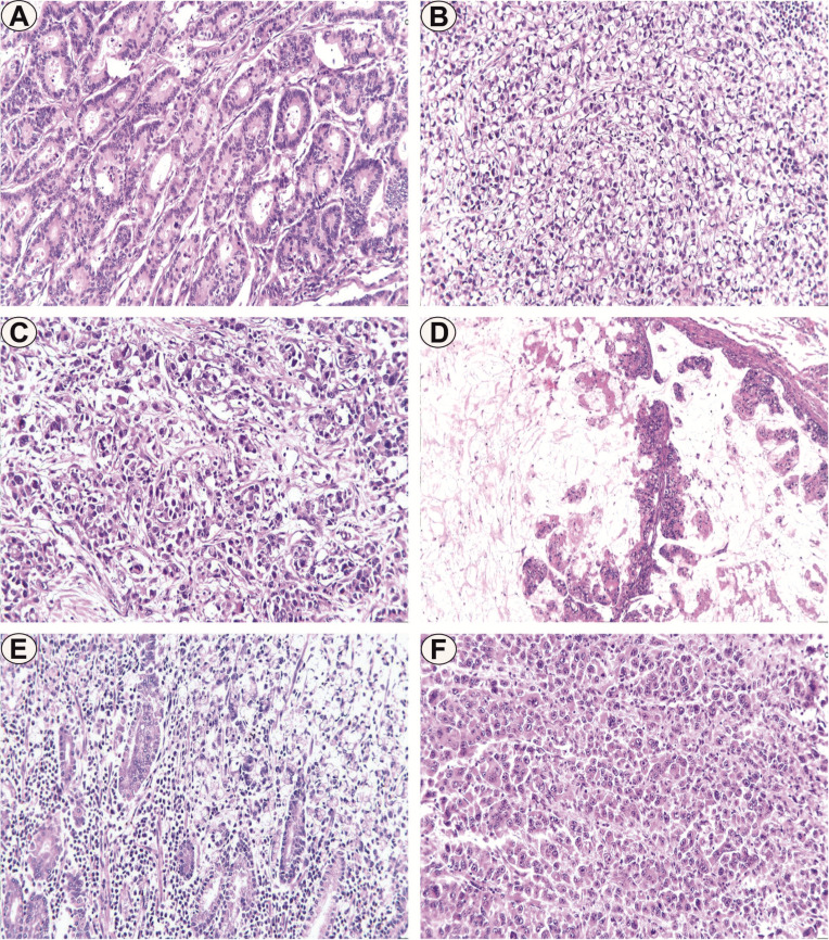 Classification and Grading Systems in Gastric Adenocarcinomas.