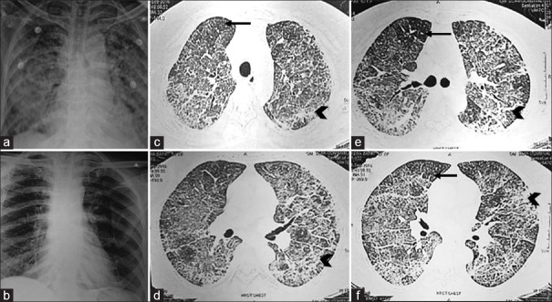 Hypercalcemia with methotrexate pneumonitis: A rare, important and intriguing adverse event.