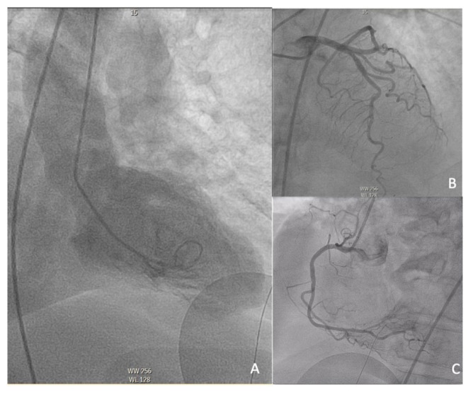 Takotsubo Cardiomyopathy in a Vaccinated Patient with Severe COVID-19.