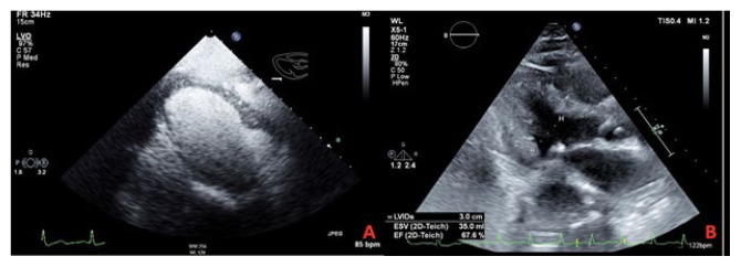 Takotsubo Cardiomyopathy in a Vaccinated Patient with Severe COVID-19.