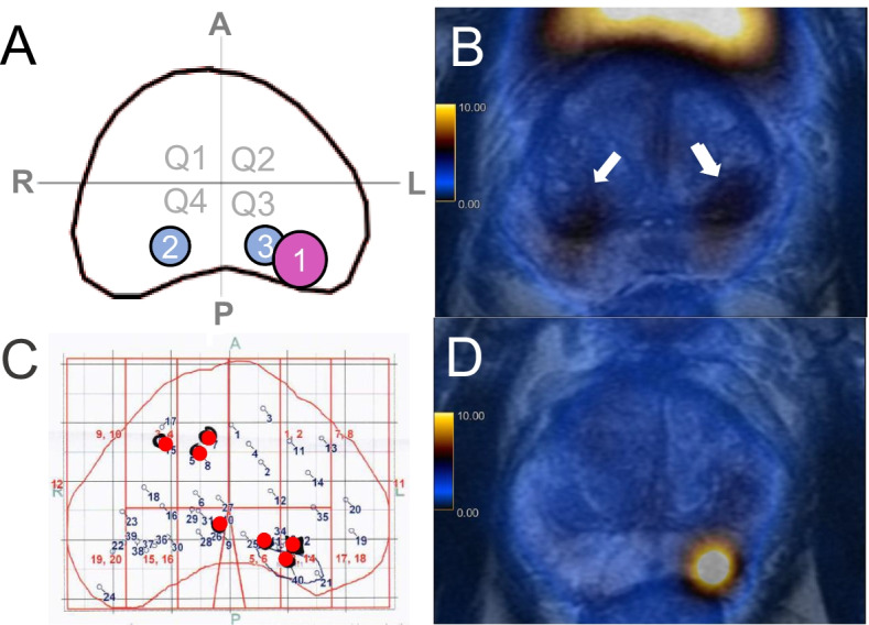 <sup>68</sup>Ga-PSMA-11 PET/MRI versus multiparametric MRI in men referred for prostate biopsy: primary tumour localization and interreader agreement.