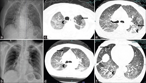 Hypercalcemia with methotrexate pneumonitis: A rare, important and intriguing adverse event.