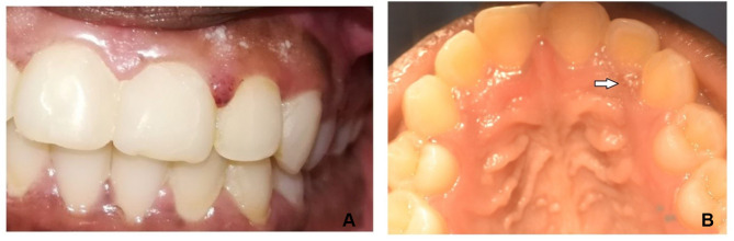 Lymphangioma Circumscriptum - A Rare Cause of Gingival Enlargement: A Case Report and Review of Literature.