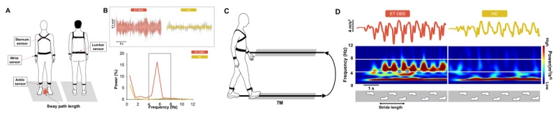 Suppression of Axial Tremor by Deep Brain Stimulation in Patients with Essential Tremor: Effects on Gait and Balance Measures.