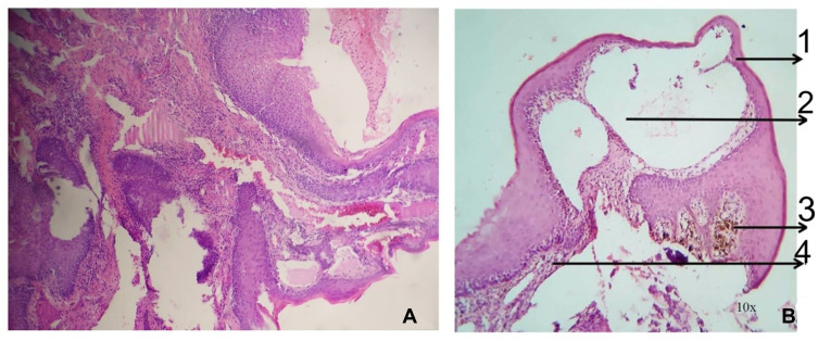 Lymphangioma Circumscriptum - A Rare Cause of Gingival Enlargement: A Case Report and Review of Literature.