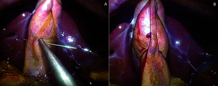 Single-Port Cholecystectomy for Cholecystitis Versus Non-Cholecystitis.