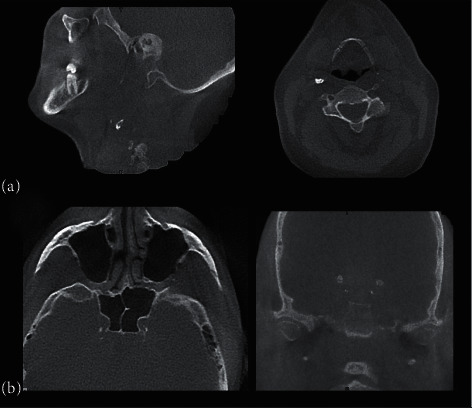 Comparison of Intracranial and Extracranial Carotid Artery Calcifications between Obstructive Sleep Apnea Patients and Healthy Individuals: A Combined Cone-Beam Computed Tomography and Polysomnographic Study.