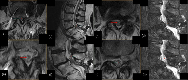 "GatorSign" for severe lumbar spinal canal stenosis: Magnetic resonance imaging evidence of lumbar perineural edema in the central canal.