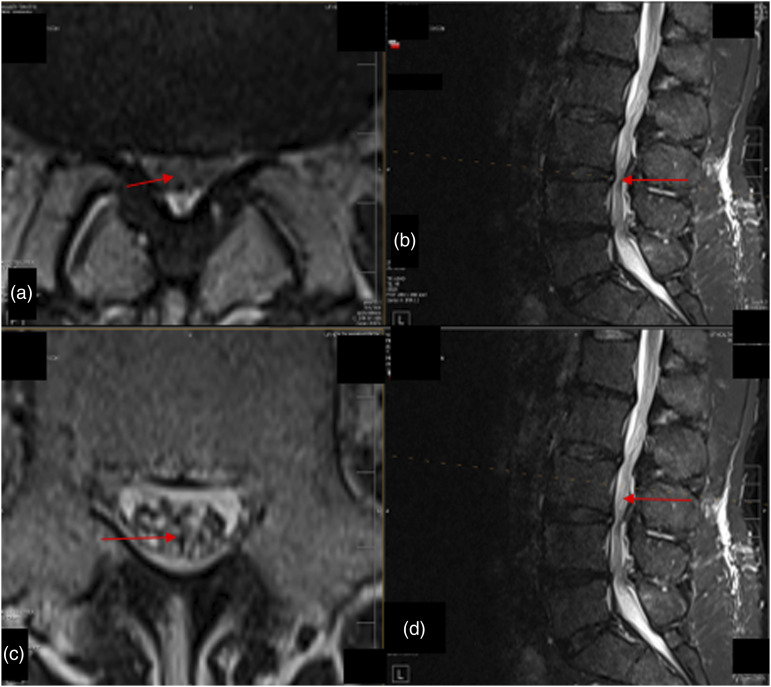 "GatorSign" for severe lumbar spinal canal stenosis: Magnetic resonance imaging evidence of lumbar perineural edema in the central canal.