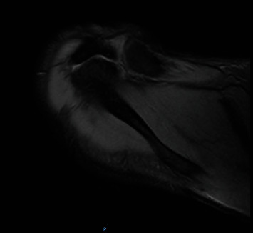 Arthroscopic Fixation of Symptomatic Meso-Type Os Acromiale: Technical Note.