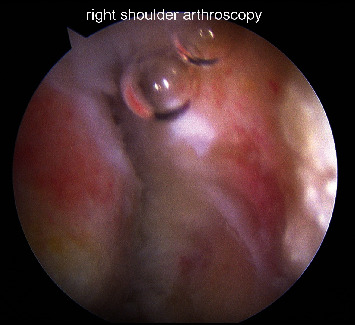 Arthroscopic Fixation of Symptomatic Meso-Type Os Acromiale: Technical Note.