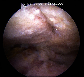 Arthroscopic Fixation of Symptomatic Meso-Type Os Acromiale: Technical Note.