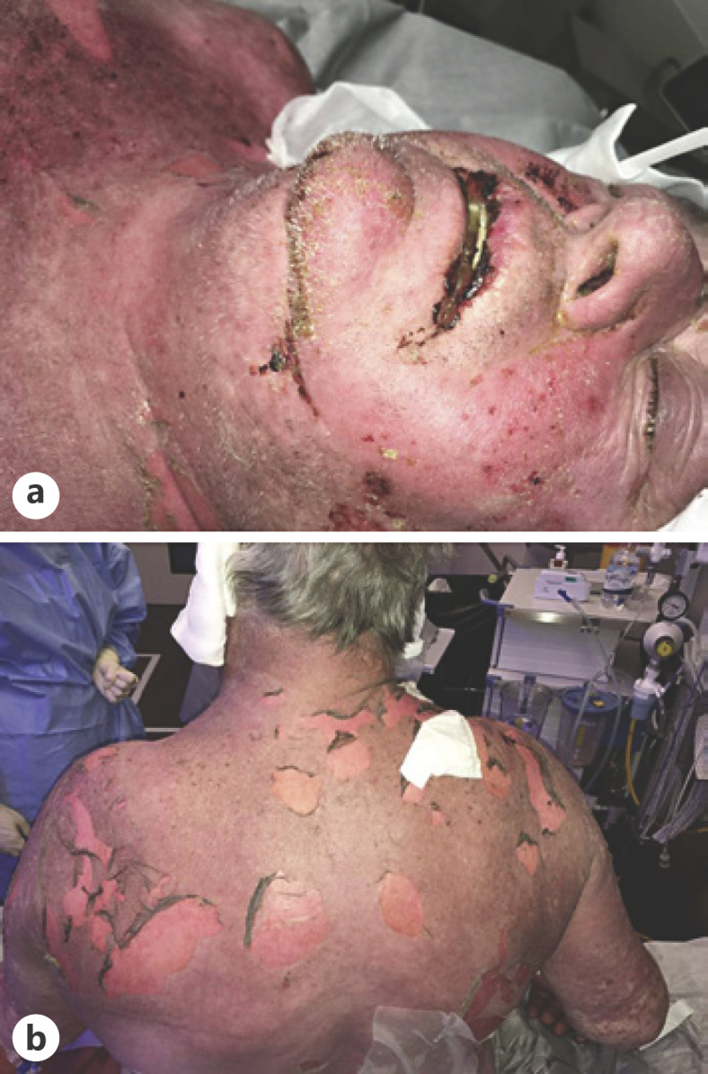 Severe Toxic Epidermal Necrolysis and Drug Reaction with Eosinophilia and Systemic Symptoms Overlap Syndrome Treated with Benralizumab: A Case Report.