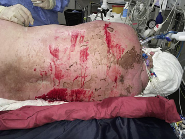 Severe Toxic Epidermal Necrolysis and Drug Reaction with Eosinophilia and Systemic Symptoms Overlap Syndrome Treated with Benralizumab: A Case Report.