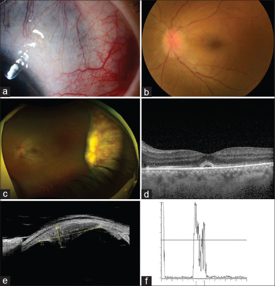 Peripheral Subretinal Mass Complicating Necrotizing Anterior Scleritis in a Patient with Granulomatosis with Polyangiitis.