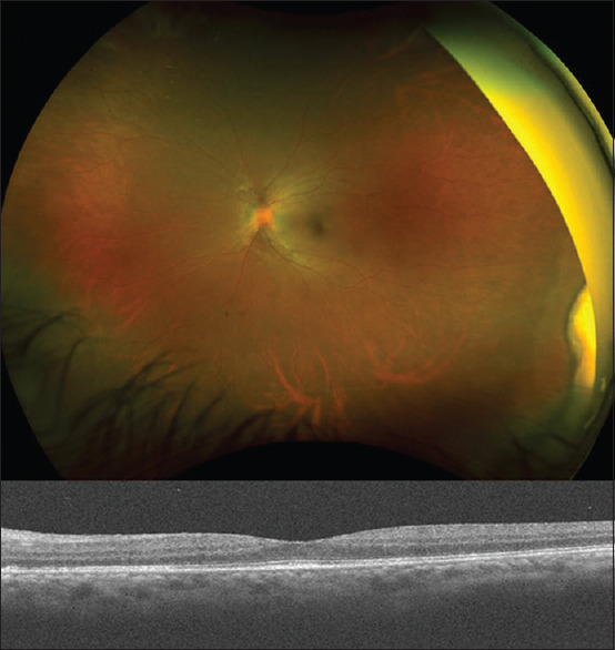 Peripheral Subretinal Mass Complicating Necrotizing Anterior Scleritis in a Patient with Granulomatosis with Polyangiitis.