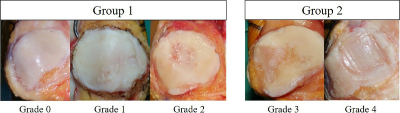 Does the degree of intraoperatively identified cartilage loss affect the outcomes of primary total knee arthroplasty without patella resurfacing? A prospective comparative cohort study.