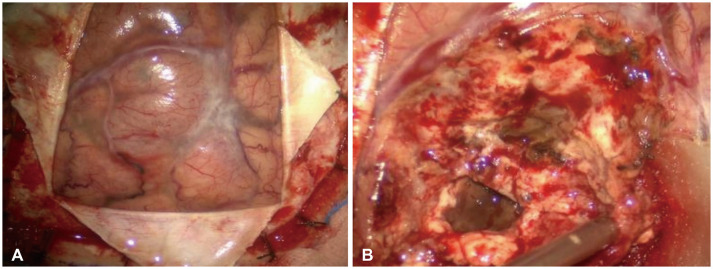 Cerebral Microangiopathy Mimicking a High-Grade Glioma in Old Age: A Case Report.