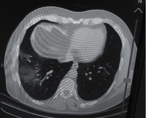 A Case Report of Acute Necrotizing Pancreatitis after COVID-19 Infection.