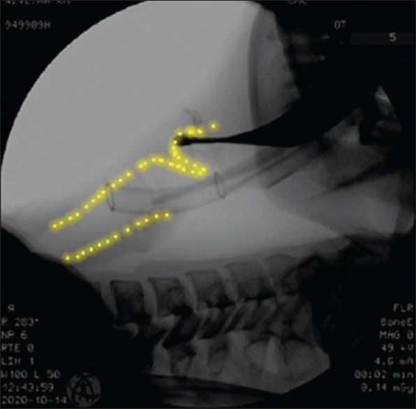 A Randomised Control Study Comparing C-MAC D-Blade Video Laryngoscope (Hyper Angulated Blade) and Macintosh Laryngoscope for Insertion of a Double-Lumen Tube in Patients Undergoing Elective Thoracotomy.