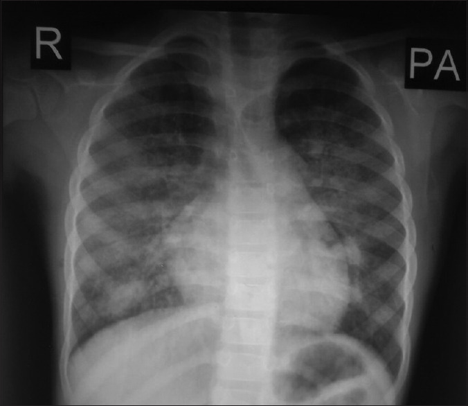 Lane-Hamilton syndrome - Is it really a needle in a haystack?