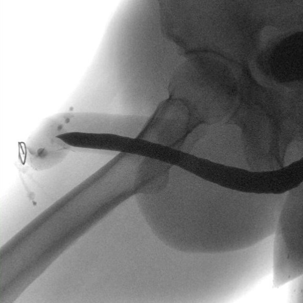 Glans Preserving Buccal Mucosa Urethroplasty for Glandular and Distal Urethral Strictures.