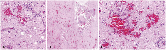 Cerebral Microangiopathy Mimicking a High-Grade Glioma in Old Age: A Case Report.