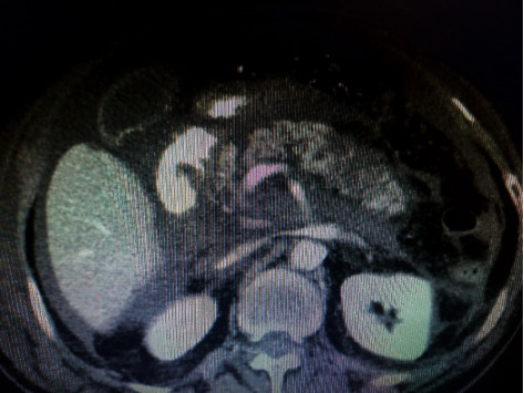 A Case Report of Acute Necrotizing Pancreatitis after COVID-19 Infection.