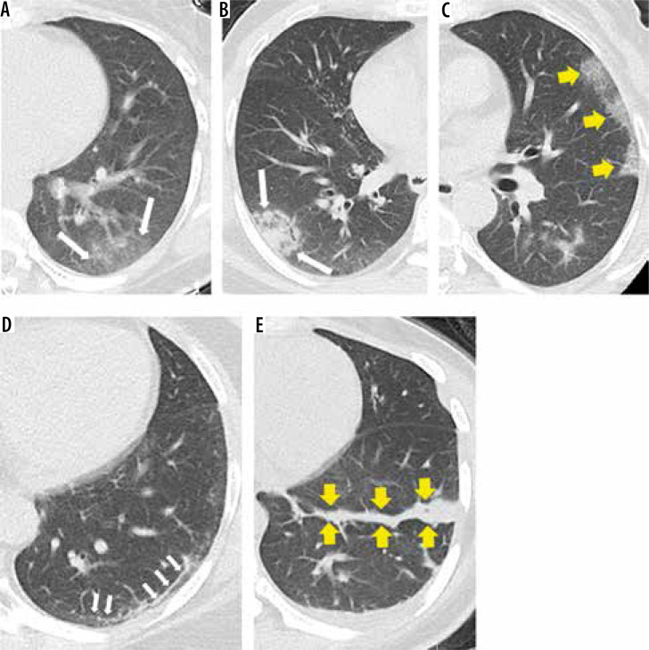 Diagnostic accuracy and prognostic value of lung ultrasound in coronavirus disease (COVID-19).