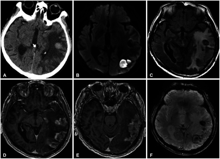 Cerebral Microangiopathy Mimicking a High-Grade Glioma in Old Age: A Case Report.