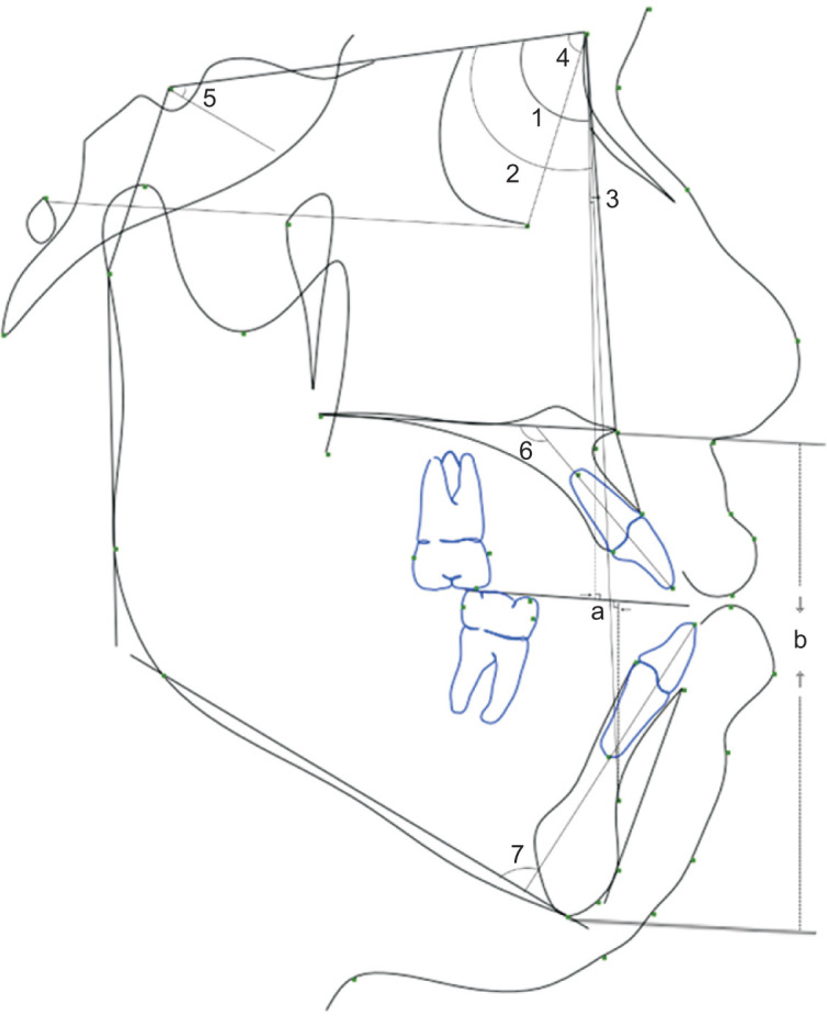 Clinical effectiveness of different types of bone-anchored maxillary protraction devices for skeletal Class III malocclusion: Systematic review and network meta-analysis.