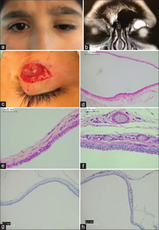 Large Conjunctival Inclusion Cyst after Anterior Approach Ptosis Surgery.