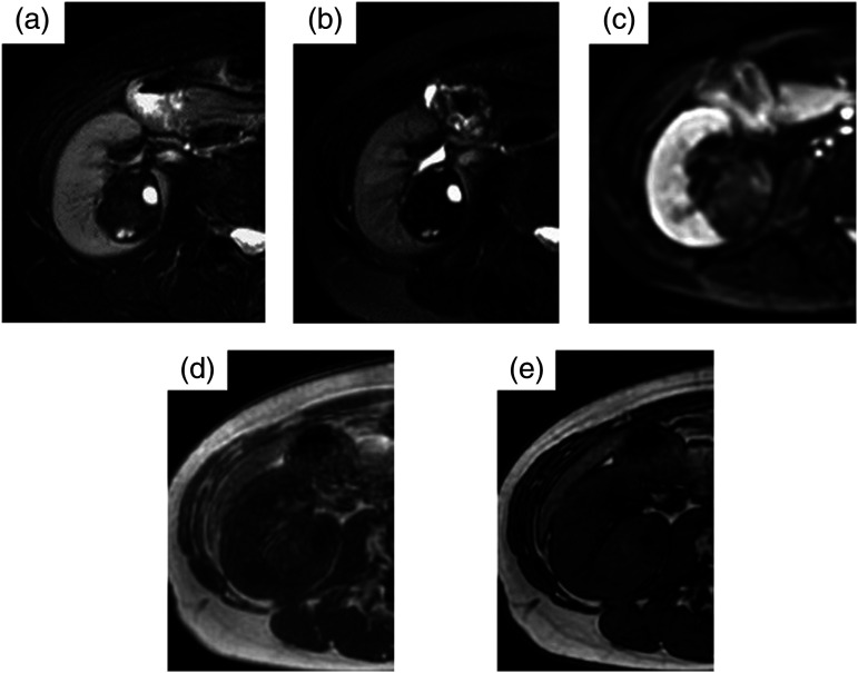 Mixed epithelial and stromal tumor of the kidney composed mainly of solid components: A case report.