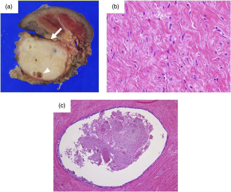 Mixed epithelial and stromal tumor of the kidney composed mainly of solid components: A case report.