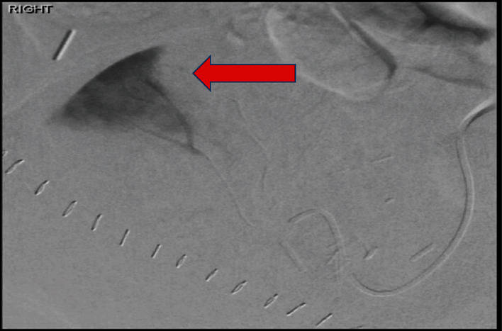 Postoperative and Recurrent Hematuria after Pretransplant Core Needle Biopsy in Living Donor Kidney Transplant.