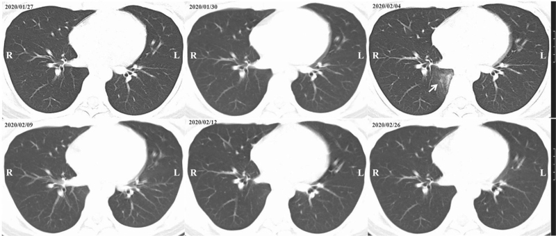 A COVID-19 Patient Discharged According to Strict Discharge Standards: Viral Negativity in Both Nasopharynx and Feces.